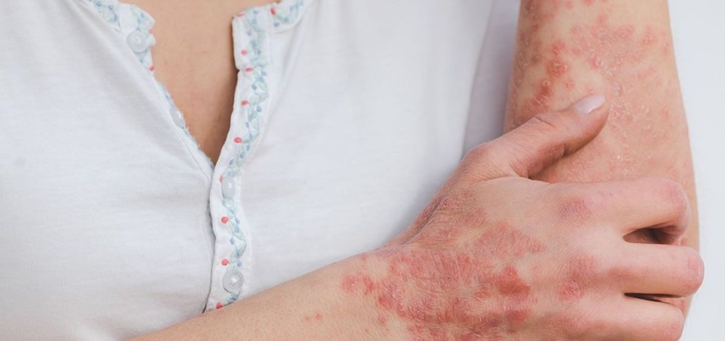 May 10: International Lupus Day | De Último Minuto English