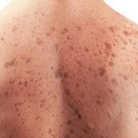 June 13: World Skin Cancer Day | De Último Minuto English
