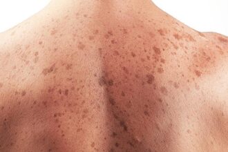 June 13: World Skin Cancer Day | De Último Minuto English