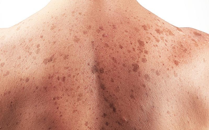 June 13: World Skin Cancer Day | De Último Minuto English
