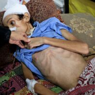 More Gazans have died from malnutrition in the first part of 2025 than in the previous two years | De Último Minuto English