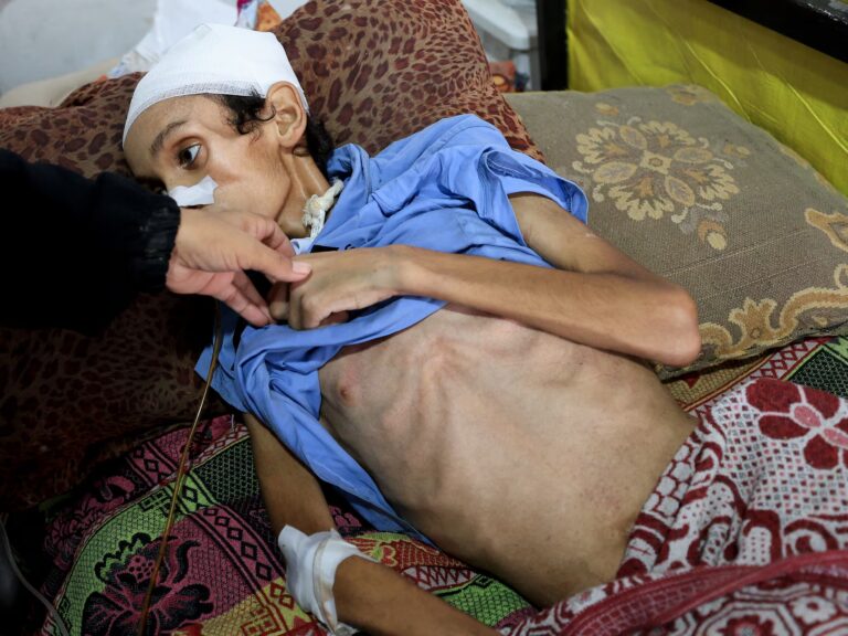 More Gazans have died from malnutrition in the first part of 2025 than in the previous two years | De Último Minuto English