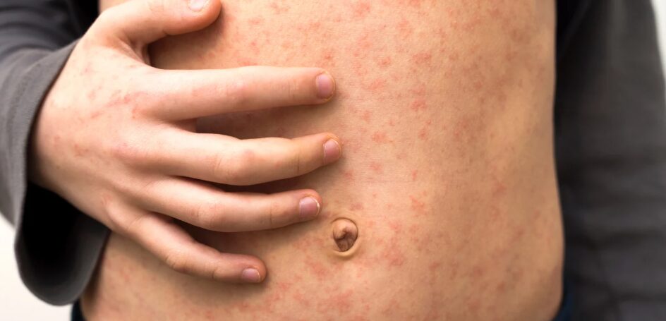 U.S. reaches, with 1,288 cases in 2025, a record of measles infections in 33 years | De Último Minuto English