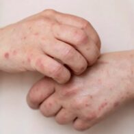 There are 44 measles cases in Paraguay and the first one outside the outbreak focus is detected | De Último Minuto English