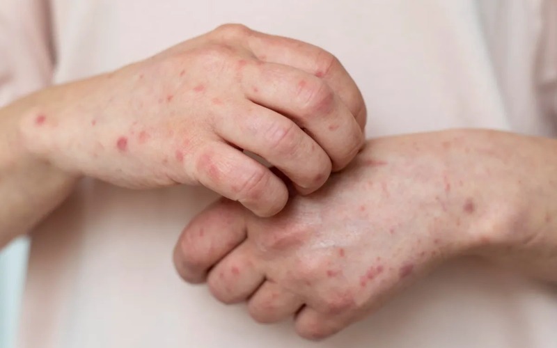 There are 44 measles cases in Paraguay and the first one outside the outbreak focus is detected | De Último Minuto English
