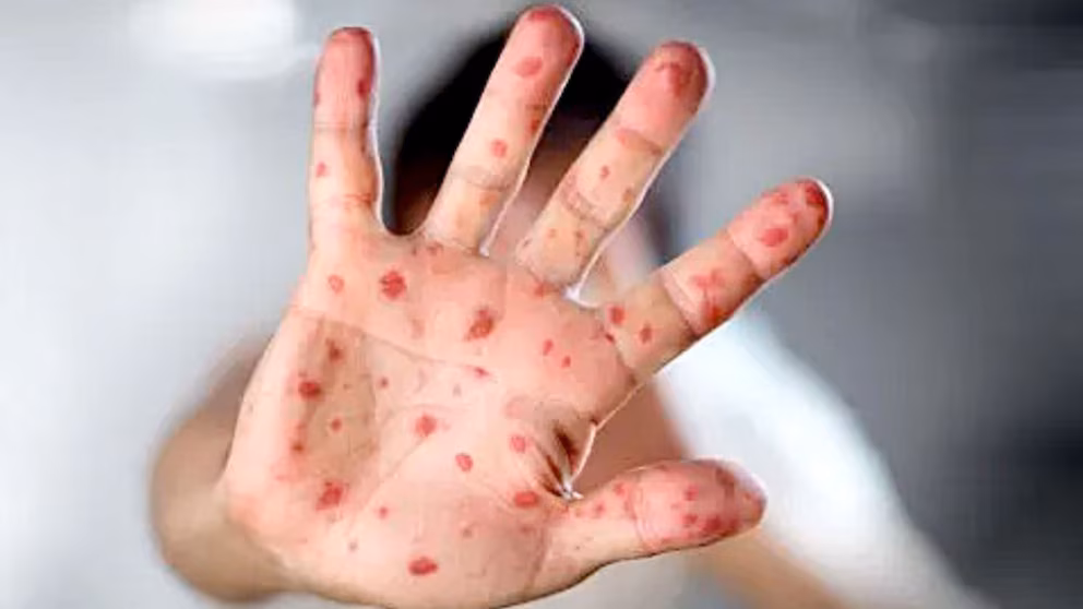 Mpox in Costa Rica: experts call for calm following reported cases in San José | De Último Minuto English