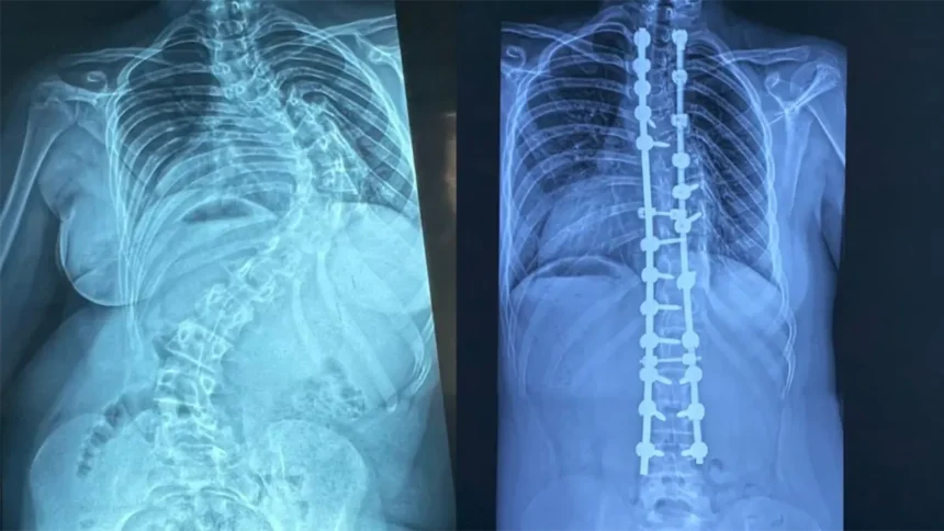 Specialists perform 347 pediatric scoliosis surgeries in the last four years | De Último Minuto English