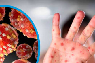 Mpox: what it is, what its symptoms are, and how it can be transmitted | De Último Minuto English