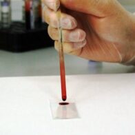 Study reveals blood test that improves detection of aggressive prostate cancer | De Último Minuto English