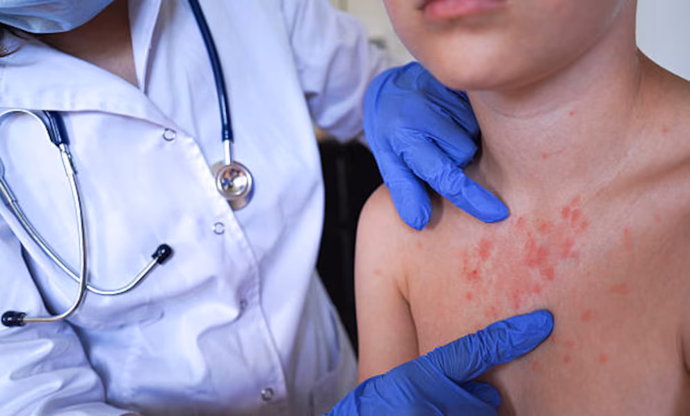 Measles exceeds 2,500 cases and 38 outbreaks in the United States, the highest figure in 35 years | De Último Minuto English