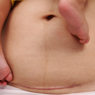 Study reveals 68.2% of births in the DR occurred via cesarean section | De Último Minuto English