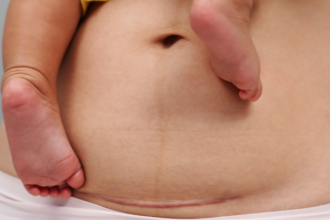 Study reveals 68.2% of births in the DR occurred via cesarean section | De Último Minuto English
