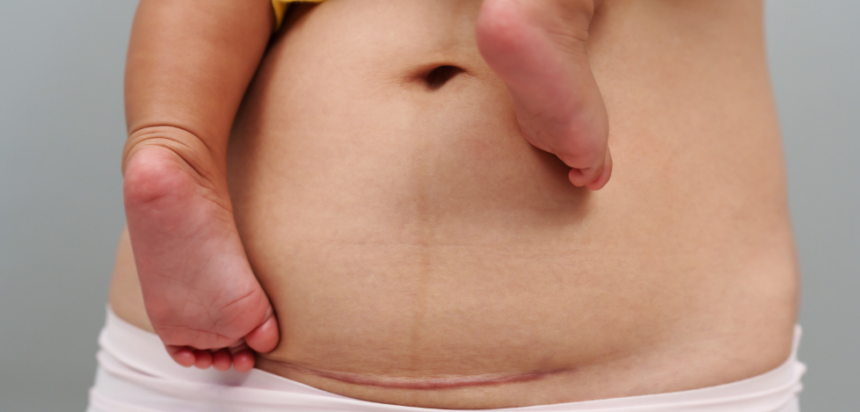Study reveals 68.2% of births in the DR occurred via cesarean section | De Último Minuto English
