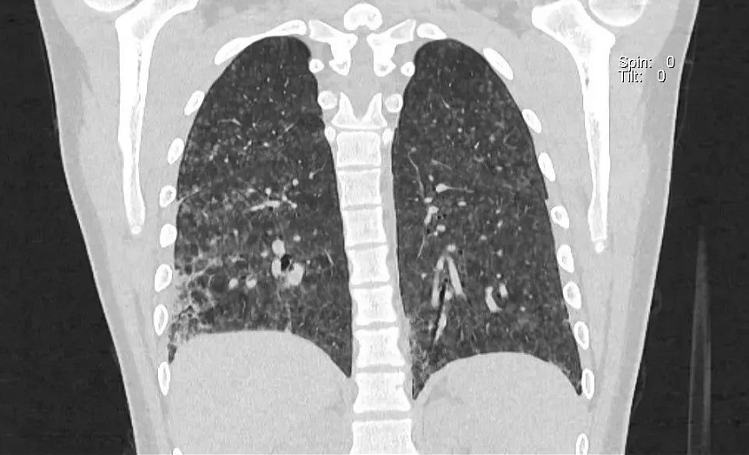 Two years of vaping leaves teenager with severe damage to both lungs