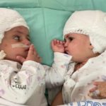 Separan a dos gemelas unidas por la cabeza tras una operación de 12 horas en Israel