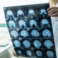 Inician en EE.UU. el primer ensayo clínico de una vacuna nasal contra el alzhéimer