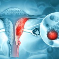Cáncer cérvicouterino, segunda causa de muerte por cáncer en mujeres entre los 35 y 64 años