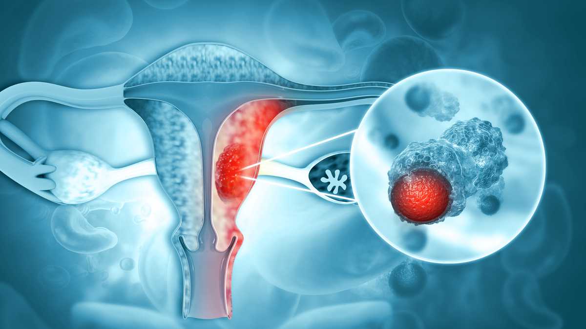 Cáncer cérvicouterino, segunda causa de muerte por cáncer en mujeres entre los 35 y 64 años