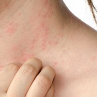 RD se mantiene alerta ante infección cutánea detectada en Haití