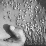 Un estudio identifica nuevos síntomas clínicos de la viruela el mono