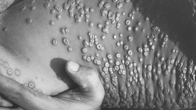 Un estudio identifica nuevos síntomas clínicos de la viruela el mono