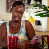 Esther Jiménez, sufrió con ácido del diablo y ahora es influencer