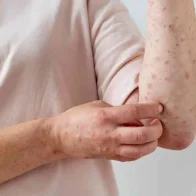 Dan de alta a los dos pacientes contagiados con viruela del mono
