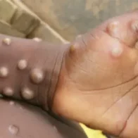 Haití, en alerta por presencia de viruela del mono en Jamaica y RD