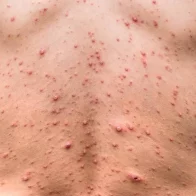 Nueva York acumula mil casos de viruela del mono, casi un tercio de todo EEUU
