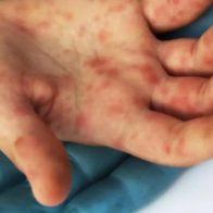 Casos de viruela símica detectados suben a 48 en Panamá