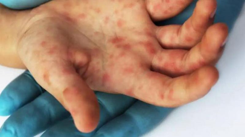 Casos de viruela símica detectados suben a 48 en Panamá
