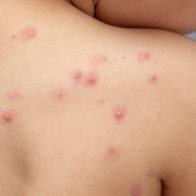 EE.UU. declarará emergencia sanitaria nacional por la viruela del mono