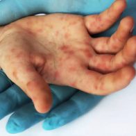 EEUU espera contener viruela del mono, pero trabaja por si se vuelve endémica