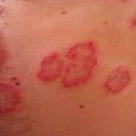 Día Mundial de la Dermatitis Atópica