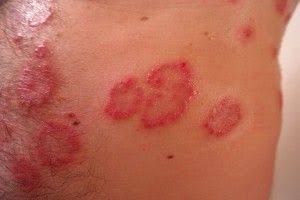 Día Mundial de la Dermatitis Atópica