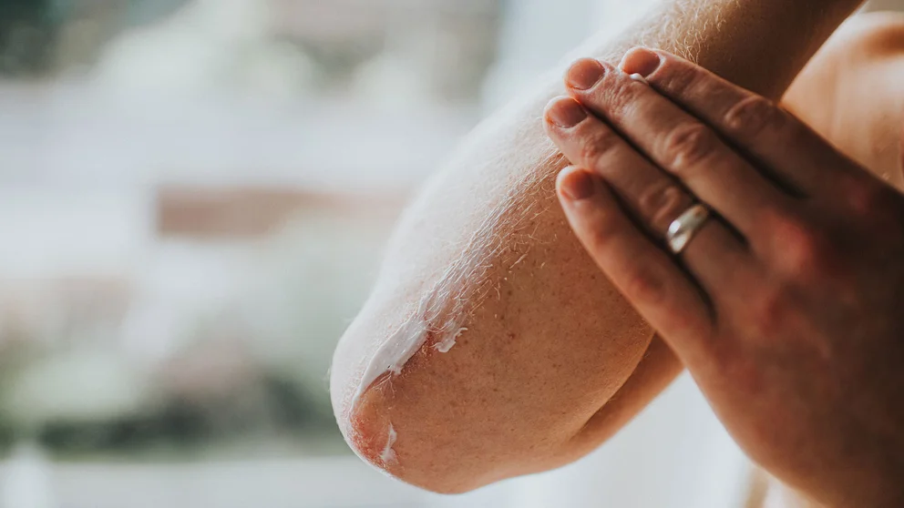 Epidermólisis