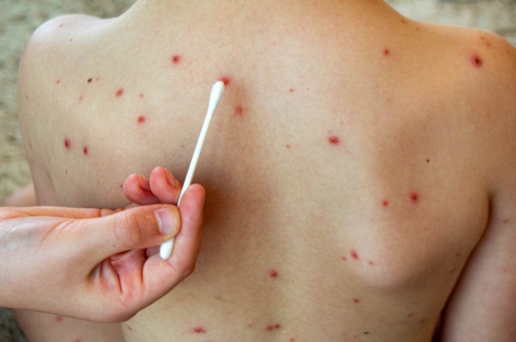 Salud Pública confirma tres nuevos casos de viruela del mono