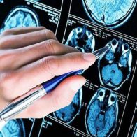 Alzhéimer precoz, una enfermedad poco frecuente con el reto del diagnóstico