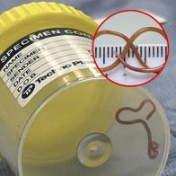 Extraen del cerebro de una australiana una lombriz intestinal viva de 8 centímetros
