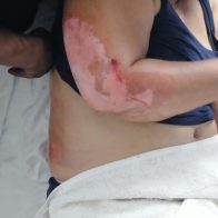 Muere mujer que resultó quemada junto a su esposo al rescatar a sus hijos durante incendio en Santiago