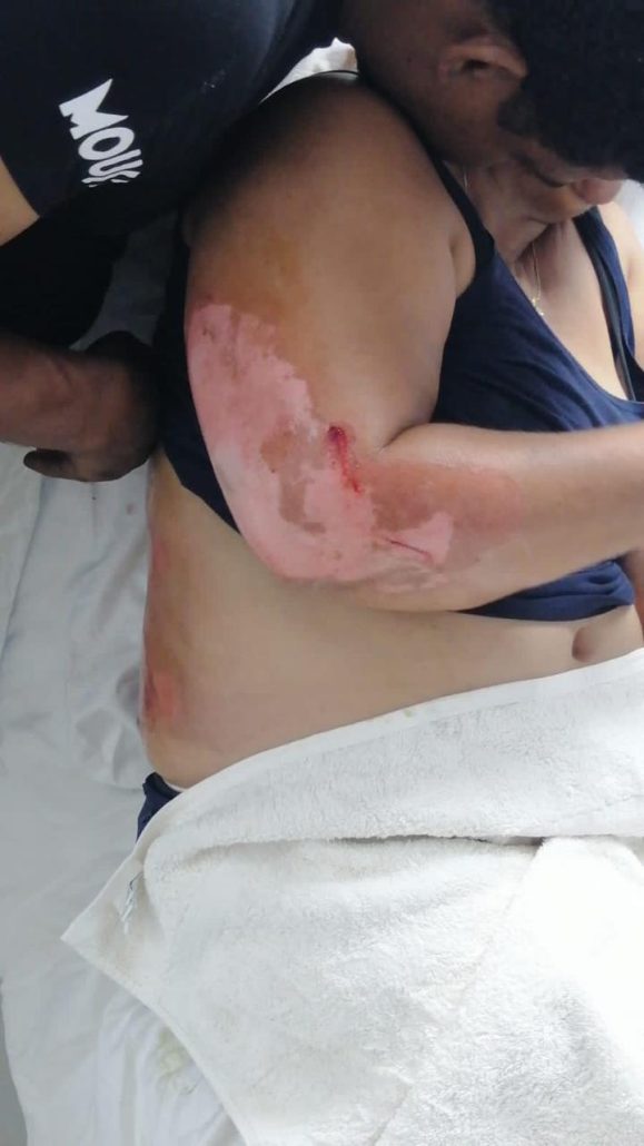 Muere mujer que resultó quemada junto a su esposo al rescatar a sus hijos durante incendio en Santiago
