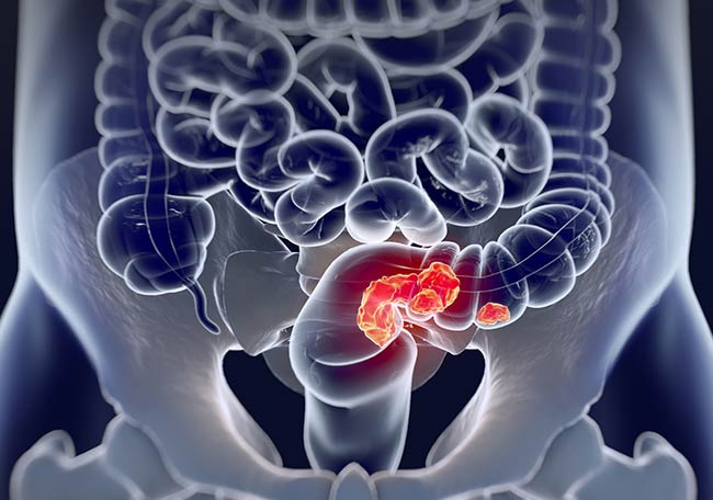 Peritonitis y Cáncer Colorrectal: Un duelo contra el tiempo