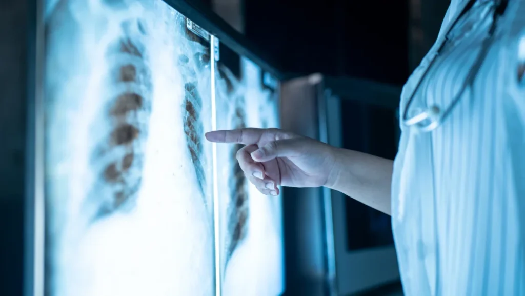 El cáncer de pulmón vuelve a ser el más común en el mundo