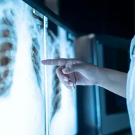 El cáncer de pulmón vuelve a ser el más común en el mundo