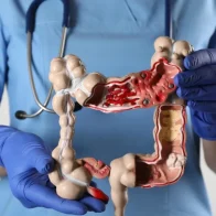 Hábitos alimenticios y ejercicios para disminuir riesgos del cáncer de colon