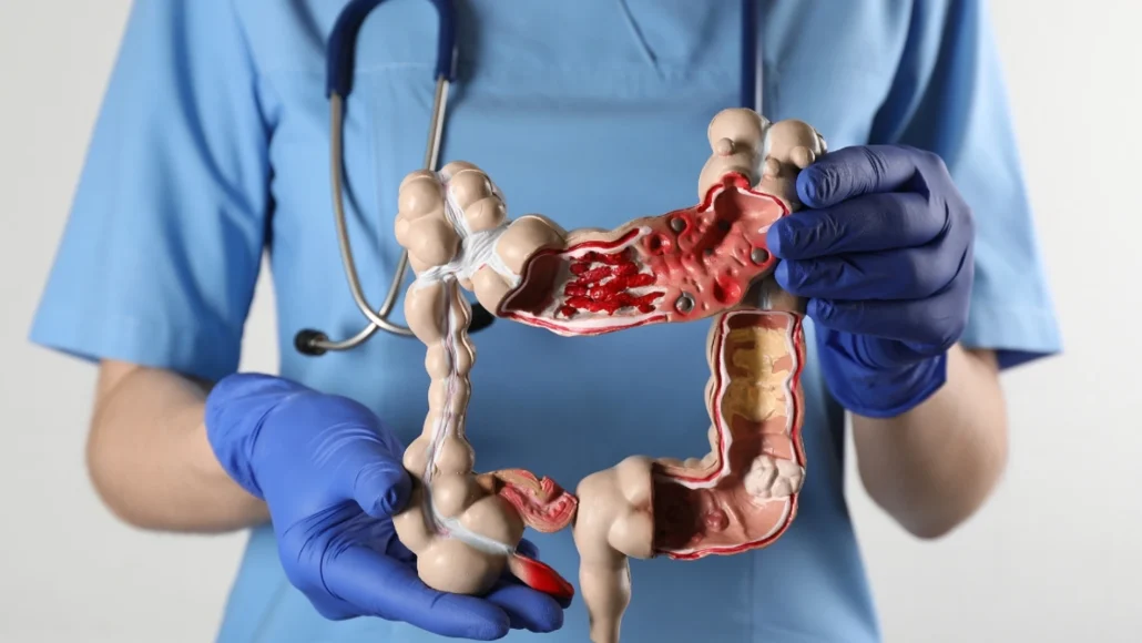Hábitos alimenticios y ejercicios para disminuir riesgos del cáncer de colon