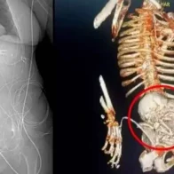 Muere mujer que llevó en su vientre un feto calcificado por 40 años