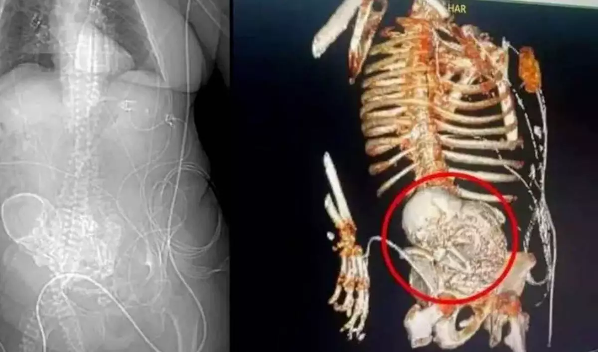 Muere mujer que llevó en su vientre un feto calcificado por 40 años