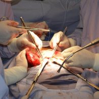 Una mujer en EEUU, segunda persona en el mundo que recibe un riñón procedente de un cerdo