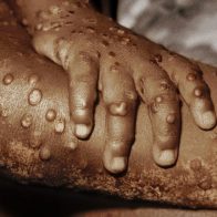 Estados Unidos advierte sobre el rebrote de la viruela del mono en África